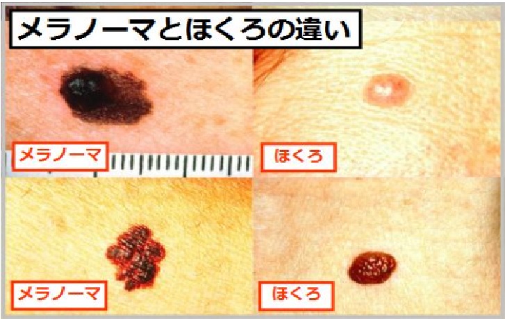 特徴 メラノーマ メラノーマ（悪性黒色腫・皮膚がん）と「ほくろ」の違いは？ メラノーマの特徴を写真で解説